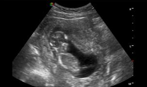 Paracetamolul administrat în timpul sarcinii poate afecta sănătatea fătului (studiu Harvard)