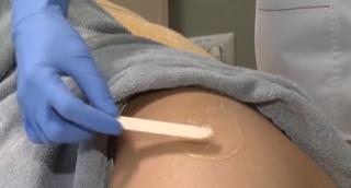 Cum scăpăm de vergeturi? Sfaturile medicilor despre tratament