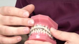 Primăria București reduce la jumătate costul aparatelor dentare. Care sunt condițiile