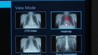 Număr record de radiografii pulmonare la Spitalul Judeţean din Timişoara, datorită unei aplicaţii