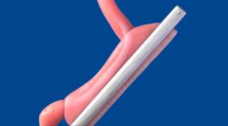 Chirurgia bariatrică, pe înțelesul tuturor. Ce presupune intervenția „Gastric Sleeve”