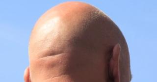 Studiu: bărbații cu chelie, mai vulnerabili în fața Covid-19