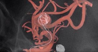 Procedură chirurgicală în premieră în România: "Astfel de intervenţii complicate vor deveni pe viitor intervenţii uzuale"