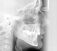 Tratamentul care regenerează dinții, descoperit de japonezi