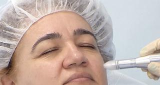 Acneea, o problemă care lasă urme neplăcute. Cum scăpăm de cicatrici