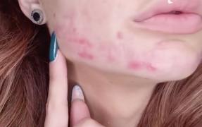 Frumuseţe tratată cu substanţe interzise prin lege. Apar tot mai multe victime ale operaţiilor estetice