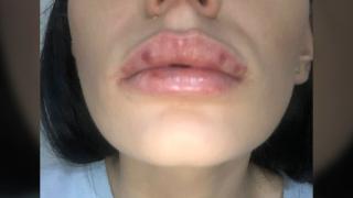 Mărturiile tulburătoare ale fetelor mutilate de falși chirurgi esteticieni, în București: "Ca şi cum mă muşcaseră vreo 7 albine"