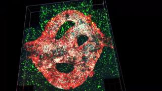 Tumoare canceroasă activă, reprodusă la imprimanta 3D. Experimentul a fost realizat la universitatea din Tel Aviv