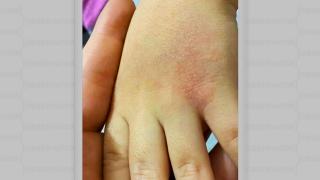 Tot mai mulți copii se întorc de la școală cu iritații pe piele și dermatite. Părinții dau vina pe dezinfectanți și caută soluții