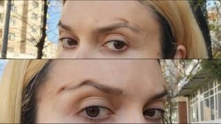 O femeie s-a ales cu găuri în față și o pagubă de 2.000 de euro, după ce a mers la un estetician fără drept de practică