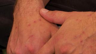 Variola maimuței, primul caz confirmat în Italia. Cum poate fi prevenită boala