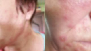 Uimitorul caz al spitalului care a confundat varicela cu pişcăturile de purici. Rudele se tem să facă plângere