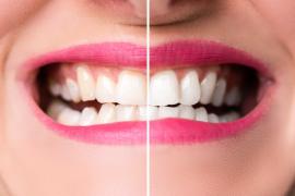Sfaturi pentru a obţine zâmbetul perfect. Paşii ce trebuie urmaţi pentru a avea o dantură impecabilă