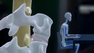 Tinerii, tot mai afectaţi de hernia de disc. Cum poate fi evitată operaţia