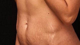 Diastaza abdominală. Care sunt cauzele, cum se manifestă şi ce tratamente există