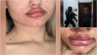 Au vrut operaţii estetice low cost şi au ajuns mutilate de o tânără de 23 de ani. "Aveam buza într-o parte, era oribilă"