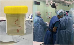 "Brusc, scoate chestia asta care mişcă". Vierme viu, găsit în creierul unei femei. Se plângea de dureri de cap, medicii credeau că are o tumoare