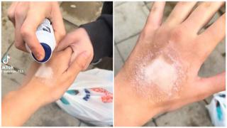 Provocarea deodorantului spray pe piele a ajuns în România. Tinerii se aleg cu cicatrici pe viață
