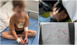 Un copil de 5 ani a înghiţit o freză la dentist, în Iaşi. A fost internat 4 zile, iar acum părinţii cer daune