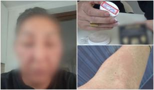 Crema cu mercur care a adus o femeie la un pas de moarte, vândută şi cu 500 de lei. "M-am trezit desfigurată"