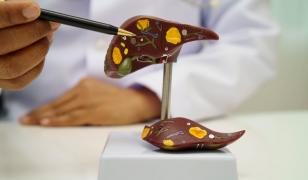 Boala ficatului gras, o problemă globală. Care este "simptomul" de care trebuie să ai grijă