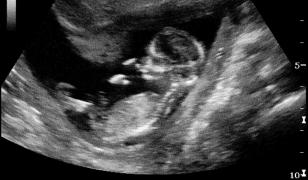 Dilema nașterii: natural sau cezariană? Trendul periculos care cuprinde și România