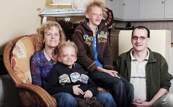 O viață chinuită! Boala care te face să arăți ca un VAMPIR