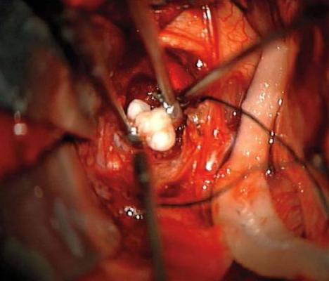 Aceşti neurochirurgi au fost şocaţi de ce au găsit în creierul unui copil!
