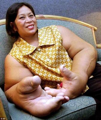 ŞOCANT! Femeia cu MÂINI DE GIGANT!