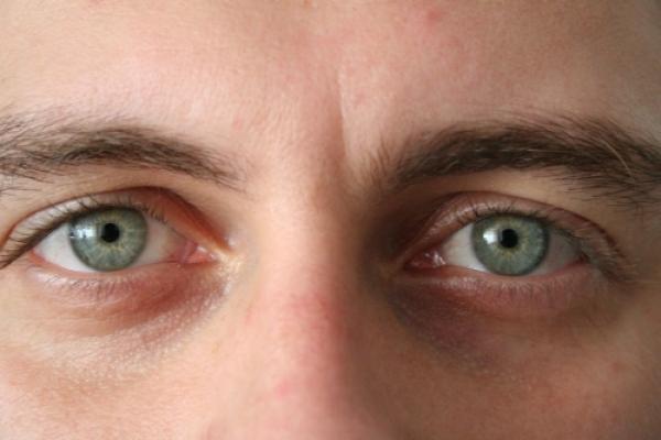 Scapă IMEDIAT de CEARCĂNE şi de RIDURILE din jurul ochilor! Ingredientul e chiar la tine în bucătărie