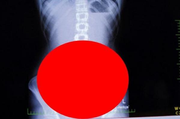 Un ieşean a ŞOCAT întreaga Românie! Ce au găsit medicii în corpul lui întrece orice imaginaţie