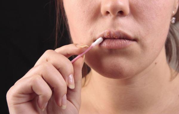 SIMPLU și RAPID! Scapă de HERPES în câteva ore cu un mic ajutor din bucătărie