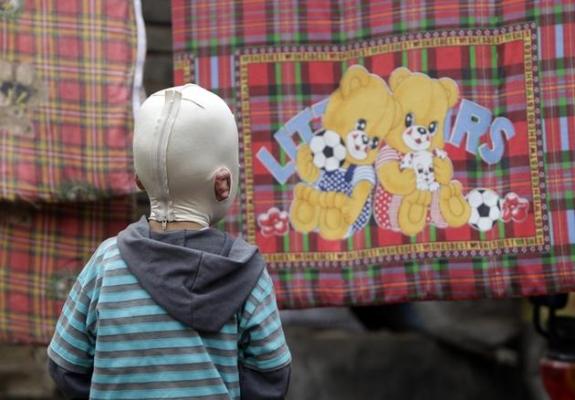 I se spune"BĂIATUL CU MASCĂ". Povestea impresionantă a unui copil mutilat