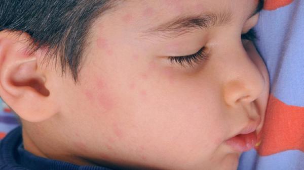 Un român a ÎMBOLNĂVIT zeci de belgieni de RUJEOLĂ