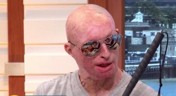 MĂRTURIA cutremurătoare a unui ROMÂN DESFIGURAT de logodnica sa, care i-a turnat în cap o sticlă de ACID SULFURIC, în timp ce dormea: “Câte vieți trebuie să fie distruse?“ (VIDEO)