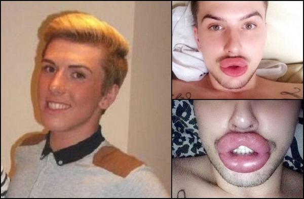 Buzele unui tânăr obsedat de Kylie Jenner, la un pas de a exploda din cauza injecțiilor. A cheltuit o avere pe operații estetice