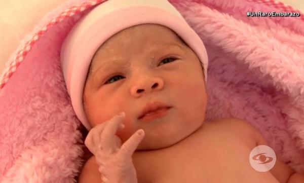 Fetiță născută cu sora geamănă în pântec