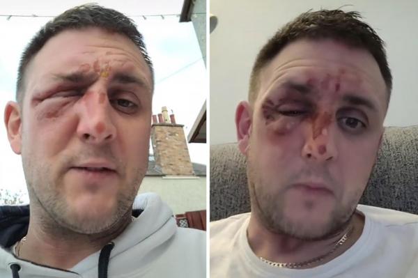 Un bărbat a ajuns la spital cu arsuri grave pe față, după ce a testat în bucătărie un truc viral pe Tiktok, în Scoția