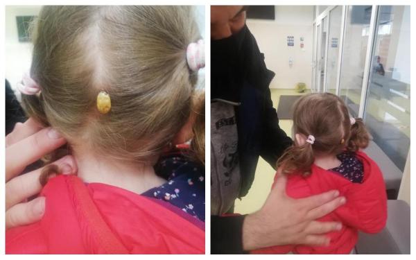 O fetiţă s-a trezit cu o căpuşă uriaşă prinsă de cap, după ce s-a jucat într-un parc din Suceava