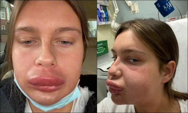 O femeie care a încercat să îşi dizolve acidul din buze a ajuns de urgenţă la spital cu faţa umflată:  "Arătam ca Homer Simpson"