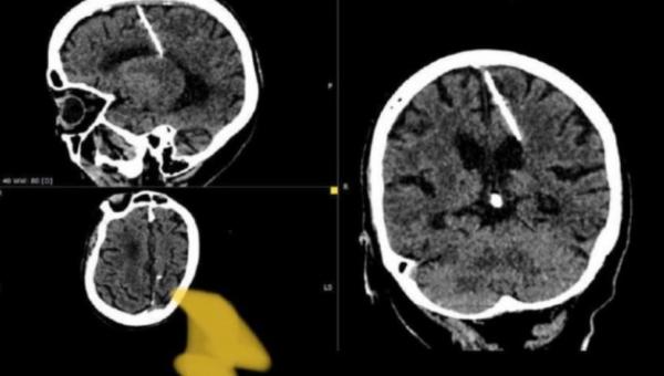O femeie din Rusia a trăit 80 de ani cu un ac înfipt în creier. Părinţii ar fi încercat să o omoare la naştere