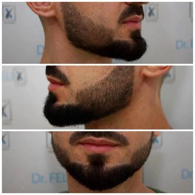 (P) Află despre transplant de păr, barbă și mustață într-un singur loc, la Dr. Felix Hair Implant