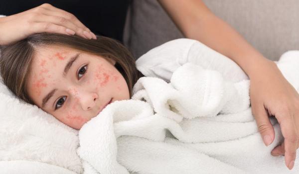 Europa se confruntă cu o explozie de cazuri de rujeolă, avertizează OMS. Numărul cazurilor în 2023, de 30 de ori mai mare faţă de 2022