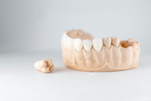(P) Cât rezistă coroanele dentare? Află durata de viață