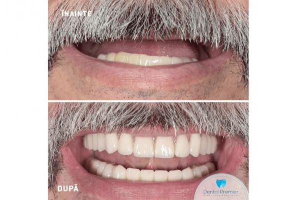 (P) Proteza dentară fixă pe implanturi: informații despre preț de la clinica Dental Premier din București