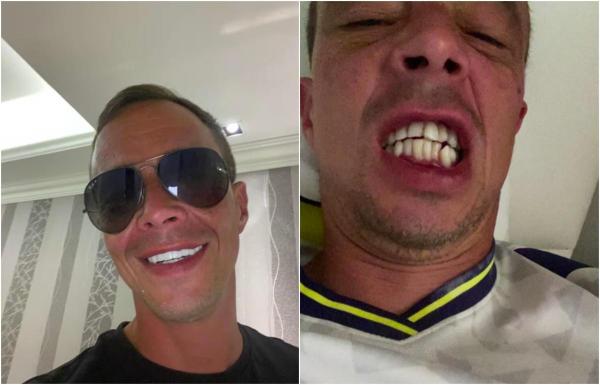 "Sunt îngrijorat de moarte". Un britanic riscă să rămână fără toţi dinţii, după o operaţie dentară în Turcia