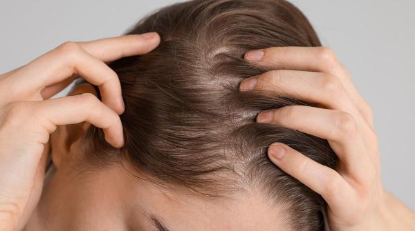 Alopecie