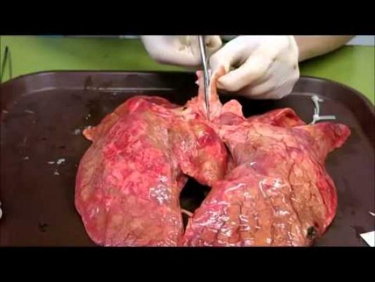 Fumezi? Iată ce se întâmplă cu PLĂMÂNII TĂI după două PACHETE DE ŢIGĂRI