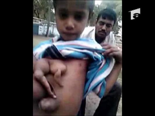 Un baiat de 7 ani s-a nascut cu 4 maini si 4 picioare