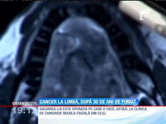 UPDATE! Cancer la limbă, după 30 de ani de fumat